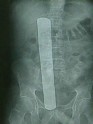 13 collas garš ķirurģiskais instruments, ko ārsti aizmirsa Donalda Čērča ķermenī. Viņam tika izmaksāta 97 000 dolāru liela kompensācija (Sietla)